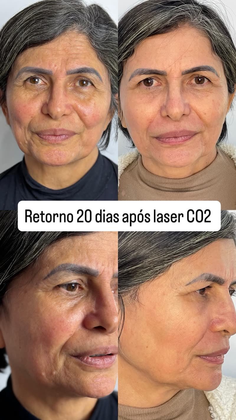 Antes e depois de laser de CO2, retorno de 20 dias