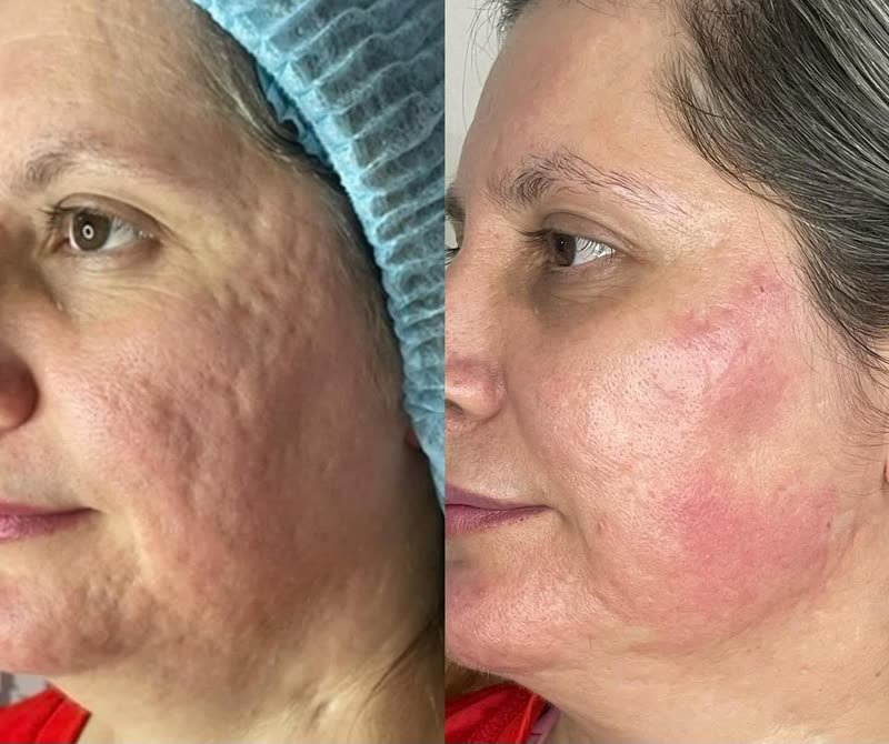 Antes e depois de laser de CO2 em cicatriz de acne