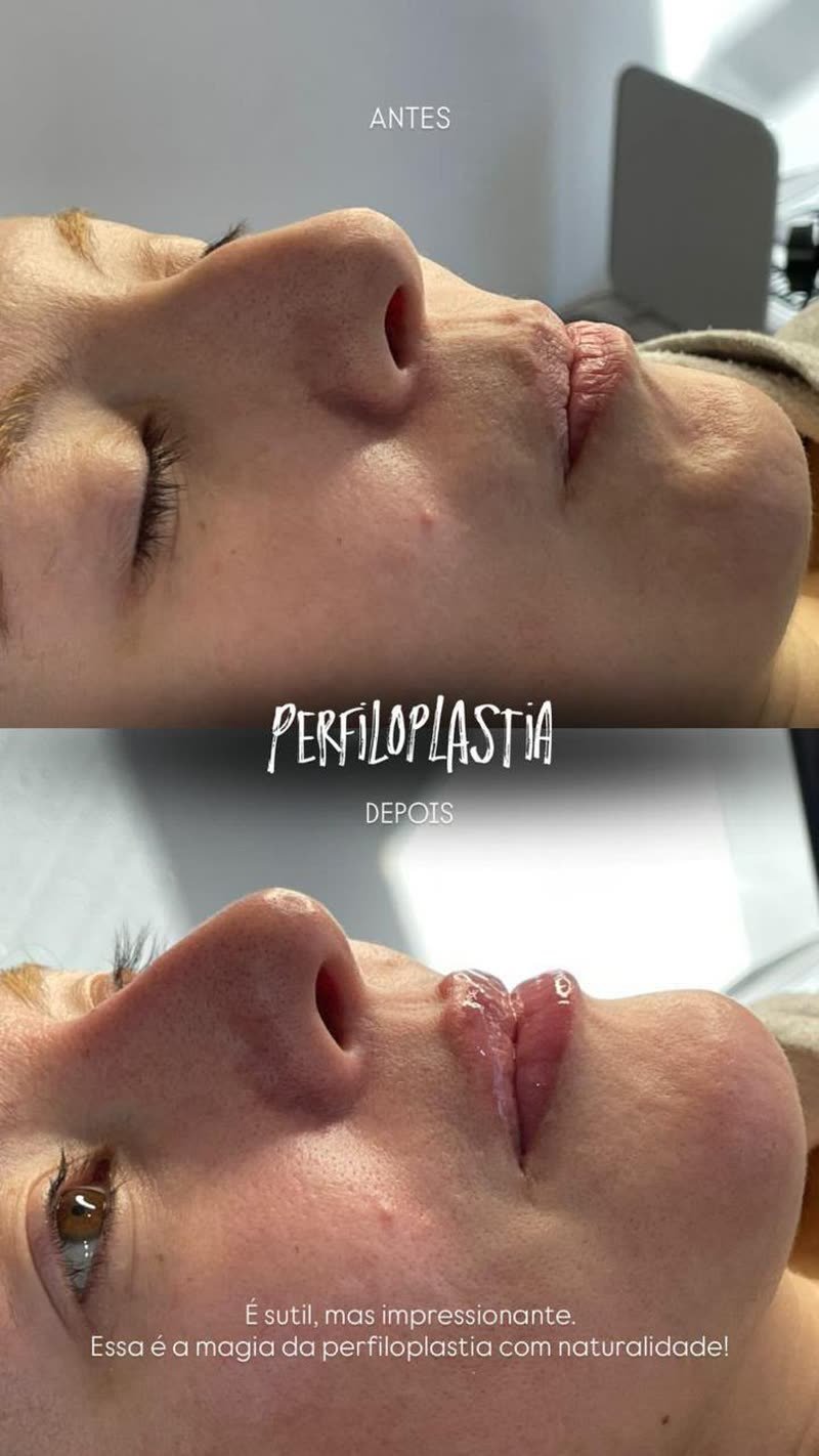 Antes e depois de perfiloplastia